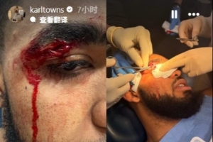 慎入！唐斯Ins晒出眉骨被撞破缝针照片并配文：一场很棒的胜利